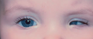 Microphthalmia - Eyes Alive